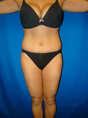 Tummy Tuck Surgery (Abdominoplasty) after 159980