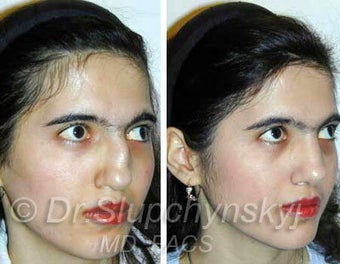 Ethnic Rhinoplasty before 374051