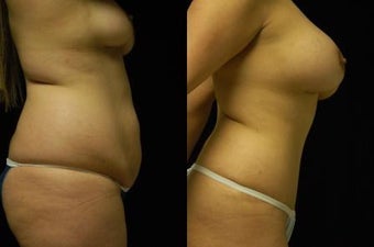 Tummy Tuck and Breast Augmentation- gel implants 392664