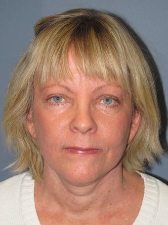 Neck Lift, Platysmaplasty after 634748