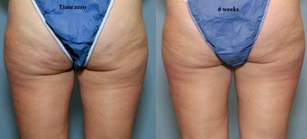 46 year old with cellulite before 644184
