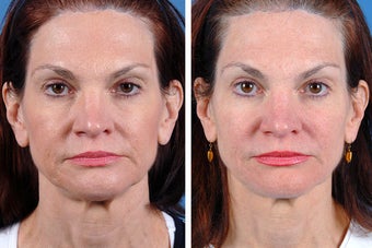 Fillers and Botox Cosmetic before 356475