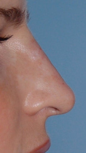 Non Surgical Rhinoplasty after 308291