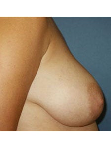 Breast Reduction before 250005