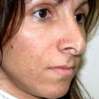Revision Rhinoplasty before 442998