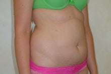 Liposuction before 177561