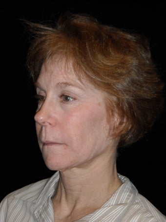 Midface lift with Endotine fixation device before 225077