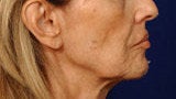Before and After Lip Augmentation before 66156