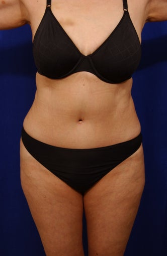 Abdominoplasty with liposculpture of abs, flanks after 82411