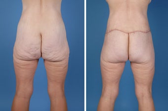 Flank Excision 303674