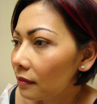 Upper eye lid surgery after 281925