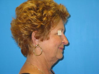 Facelift before 147388