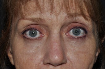 Permanent Eyeliner after 277520