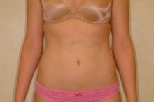 Liposuction after 177564