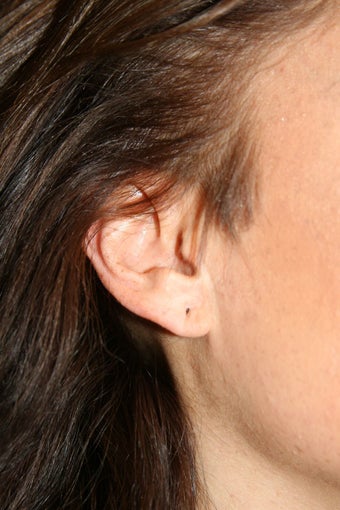 Ear Lobe Repair before 584367
