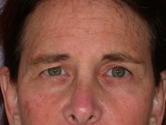Eyelid Surgery before 306453