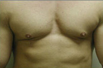 Male Breast Reduction before 141526