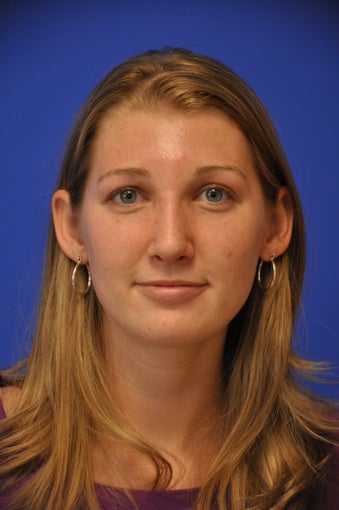 Revision Rhinoplasty 478750