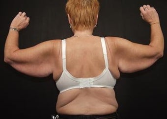 Brachioplasty (Arm Lift) before 358819