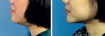 Chin Liposuction before 640730