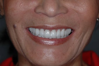 Smilemaker after 356797
