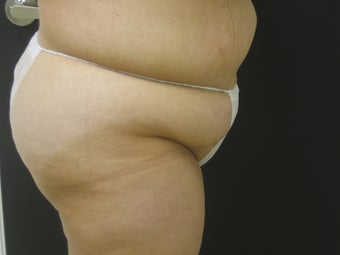 Tummy Tuck After Gastric Bypass 523251