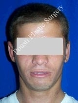 Ear Surgery (Otoplasty) 616578