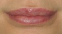Lip Surgery, Lip Reduction after 458982