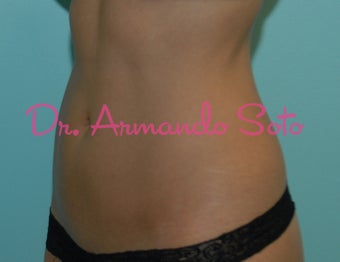 Coolsculpting by Zeltiq after 419220