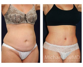 Abdominoplasty - Tummy Tuck after 396091