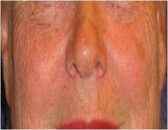 CO2 Laser Resurfacing ~ Active & Deep FX before 130743