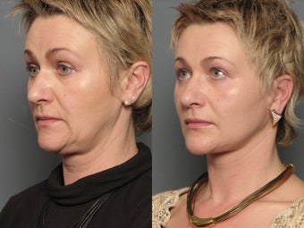 Facelift after 338469