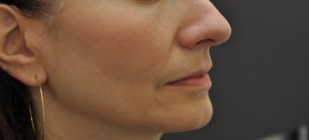 Juvederm Ultra before 194333