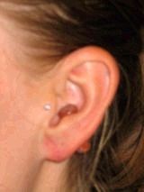 Earlobe Repair after 146612