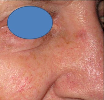 Mohs surgery defect repair after 82507