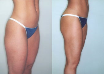 Liposuction (Thighs, Knees & Buttocks) before 350938