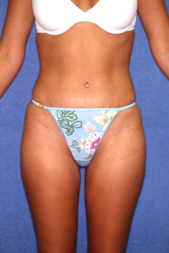 Tummy Tuck with Liposuction after 410981
