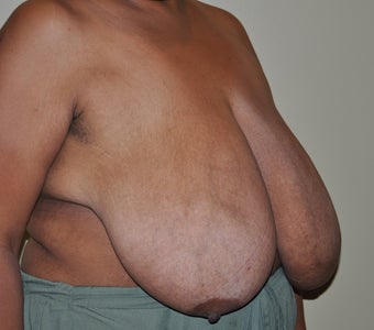 Breast Reduction 530711