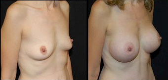 Breast Implants after 150816