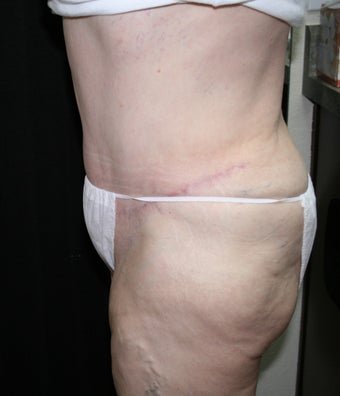 Abdominoplasty (tummy tuck) after 263037