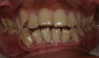Invisalign before and afters before 151758