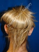 Ear Surgery (Otoplasty) before 616517