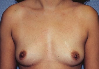 Breast Augmentation before 266786