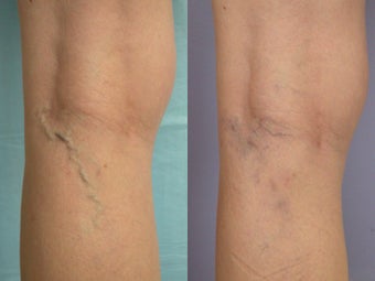 Laser Vein before 302231