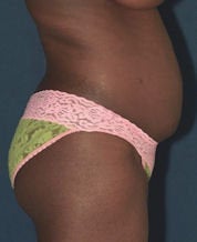 Tummy Tuck before 634166