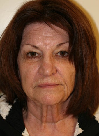 Facelift and Rhinoplasty before 216689