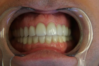 preventative decay treatment after 362259