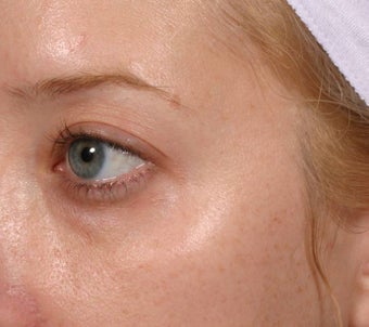 Restylane under eyes before 137841