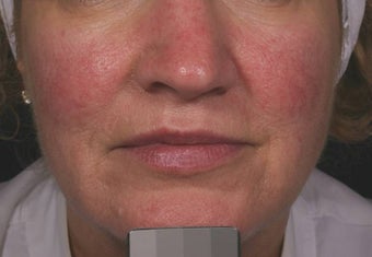 Vein treatment before 135901