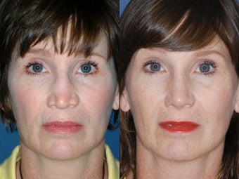 Revision rhinoplasty before 334236
